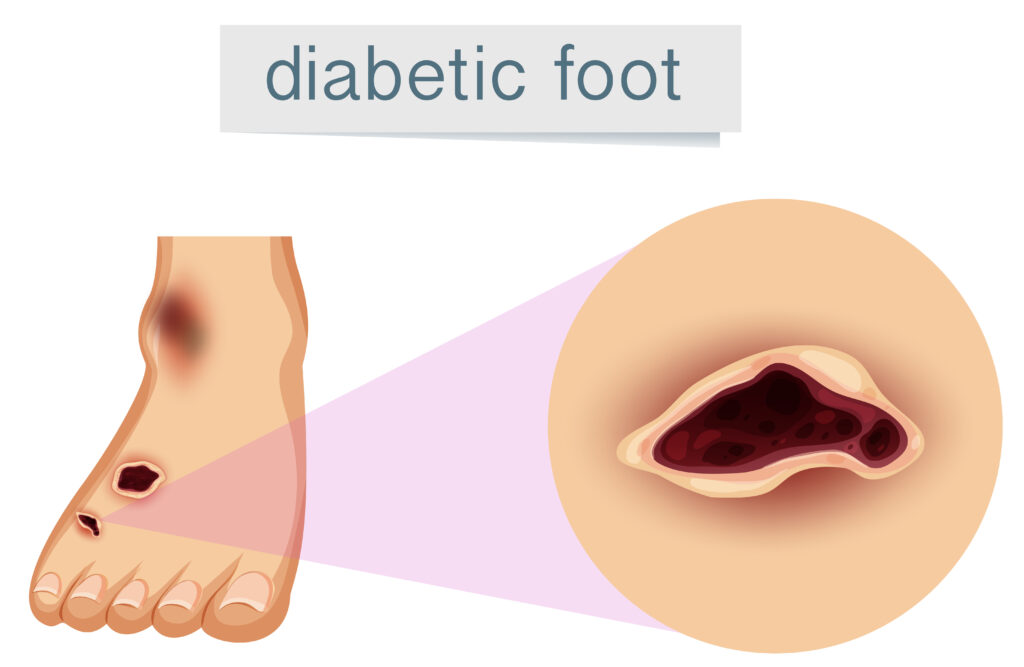 Diabetic Foot Management