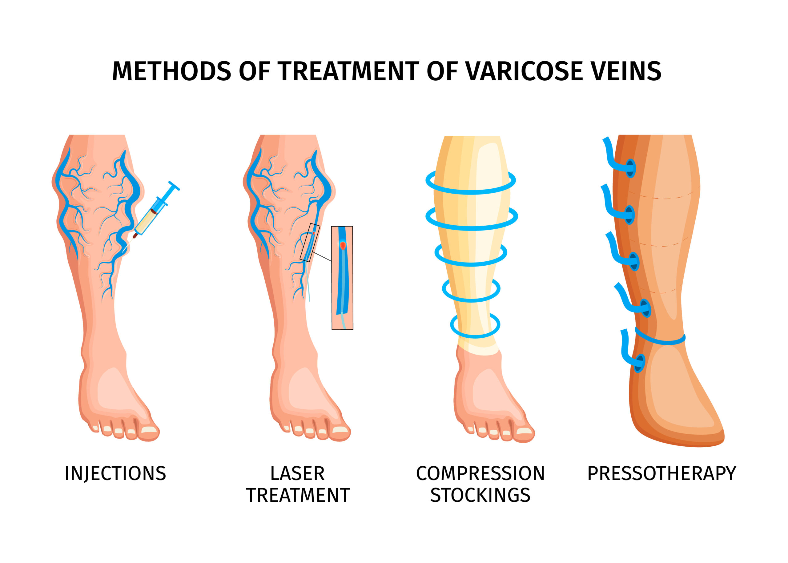 Varicose Veins Treatment